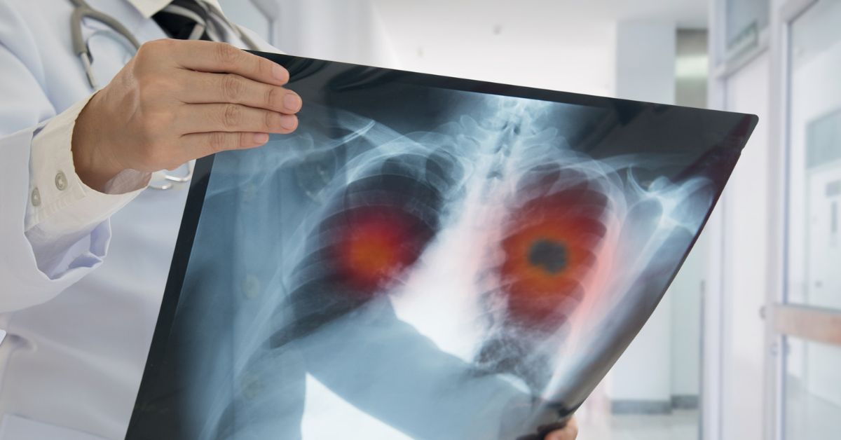 Asbestos & mesothelioma lung damage