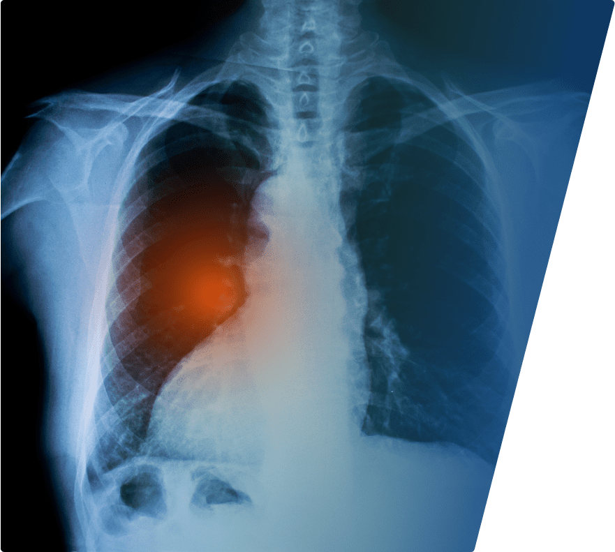 Chest X-ray showing the ribcage, spine, and lungs, with a highlighted area of concern in the left lung near the heart, indicated by a red-orange glow.