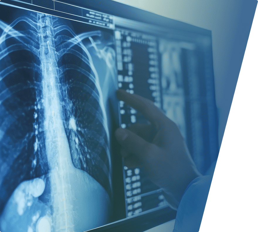 X-ray image of a human chest showing ribs, spine, and lungs, with a hand pointing at the screen.