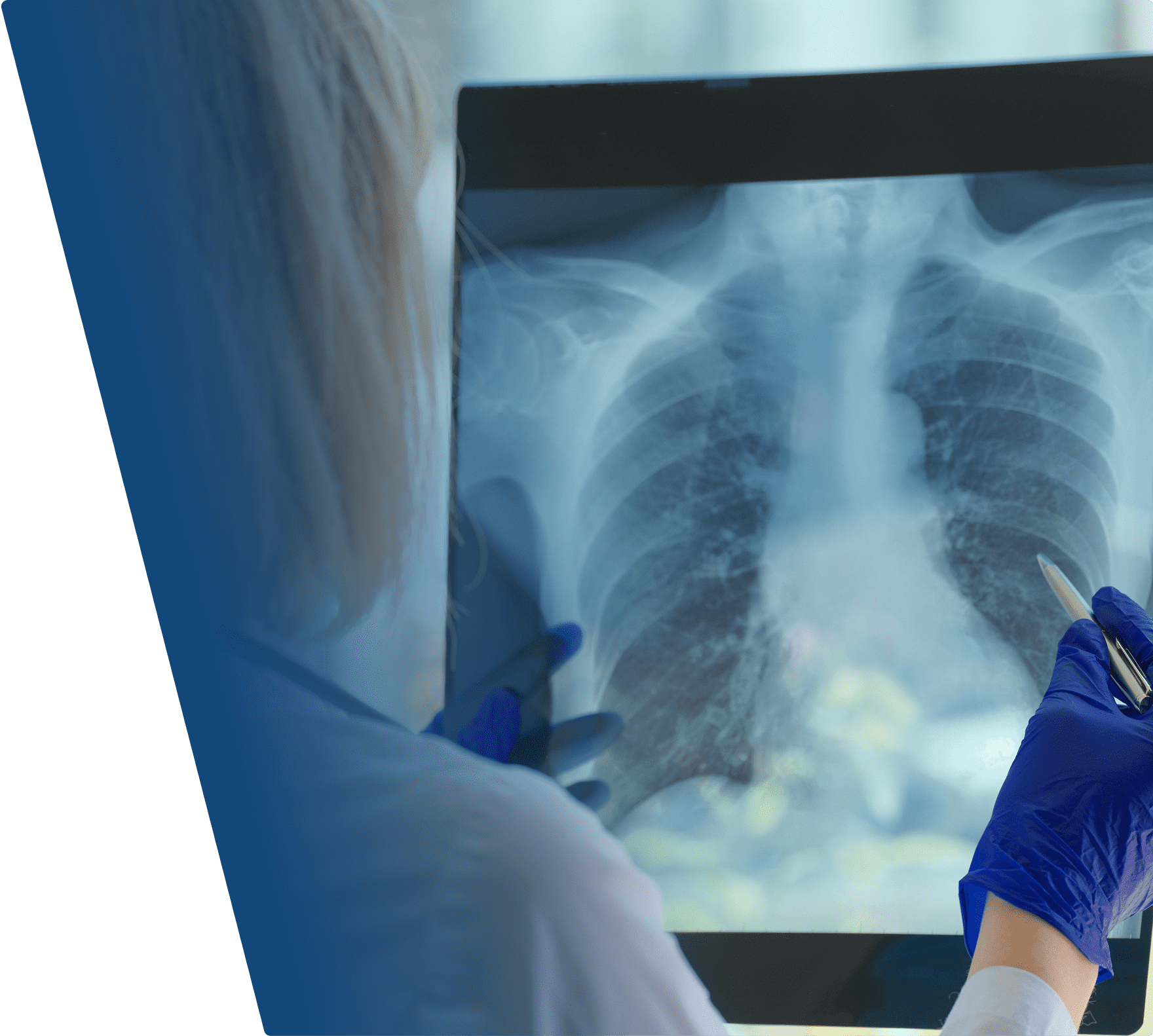A medical professional wearing blue gloves is holding and examining a chest X-ray film, which shows the ribs, lungs, and heart area. The person is pointing at the X-ray with a pen.