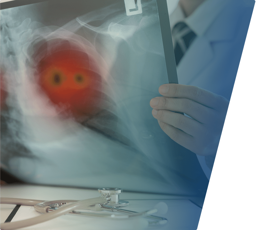 X-ray image of a chest with a highlighted red area indicating a potential abnormality or infection in the lung, held by a person wearing a white coat, with a stethoscope lying on a table in the foreground.