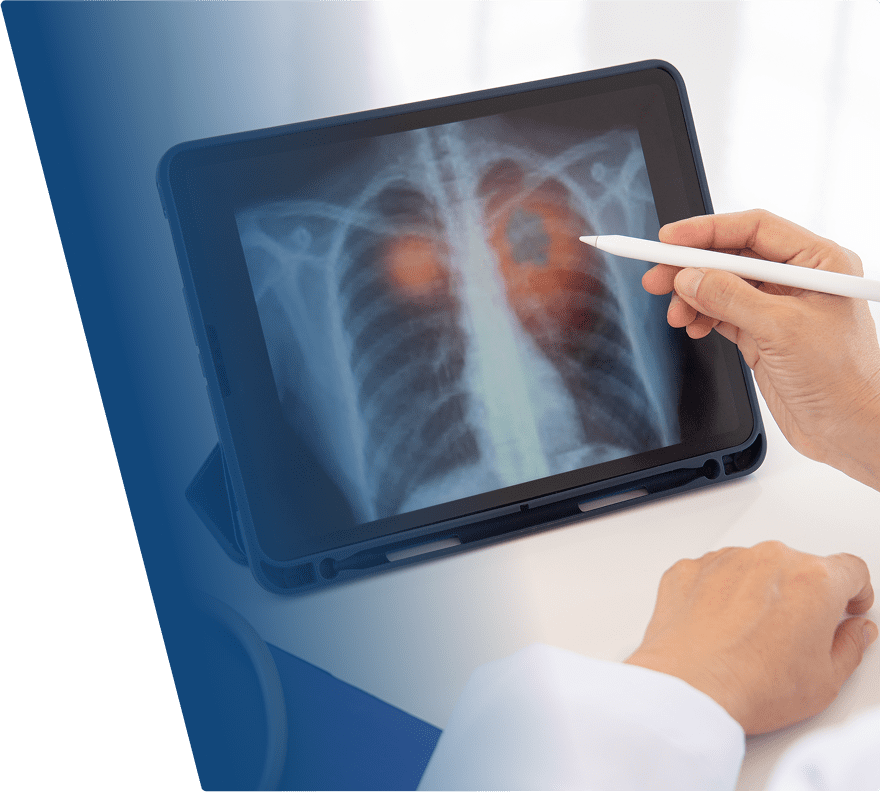 A digital tablet displaying a chest X-ray with highlighted areas in the lungs, showing a person pointing at the screen with a white stylus. The person is wearing a white coat, suggesting a medical professional analyzing the X-ray.
