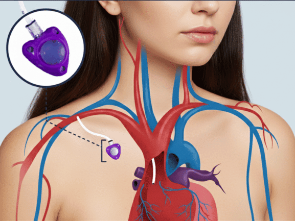 Power Port (chemo port implant) lawsuit